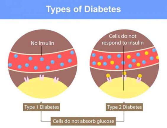 Type 1 vs. Type 2 Diabetes
