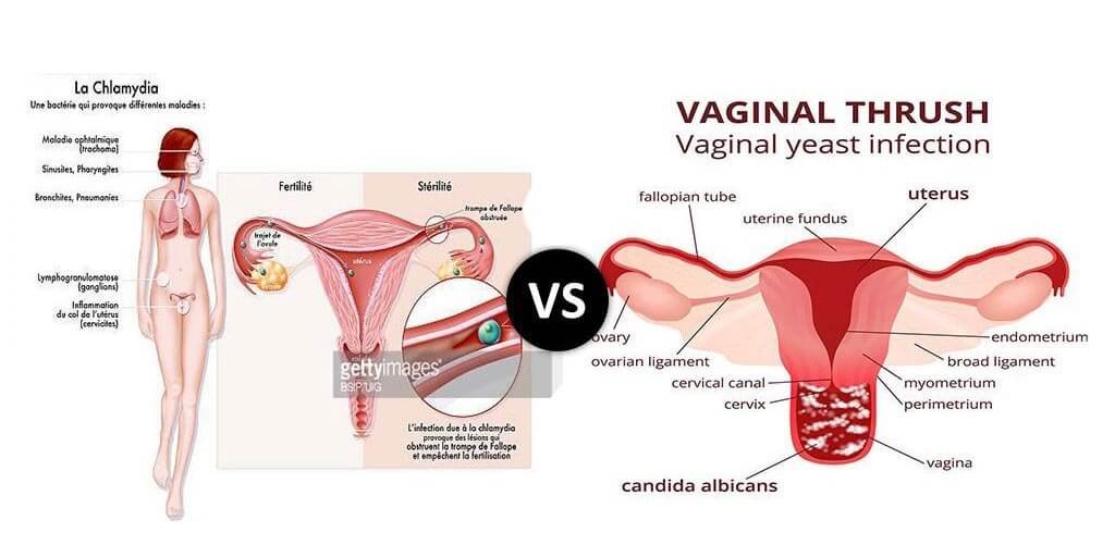 Chlamydia infection