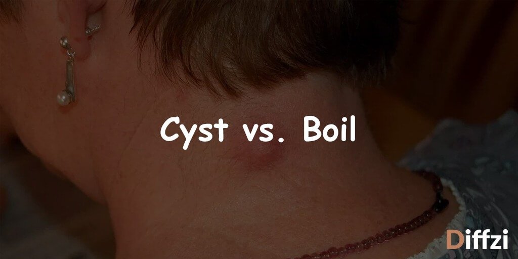 Cyst vs. Boil