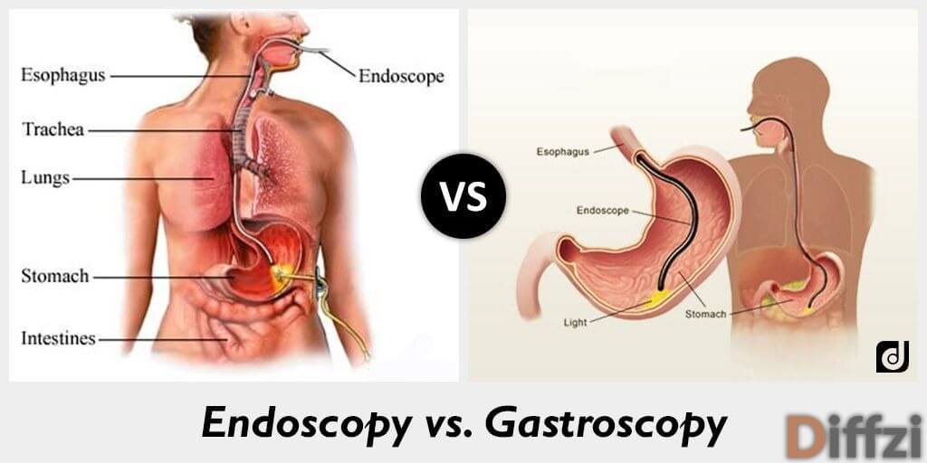 Endoscopy vs. Gastroscopy