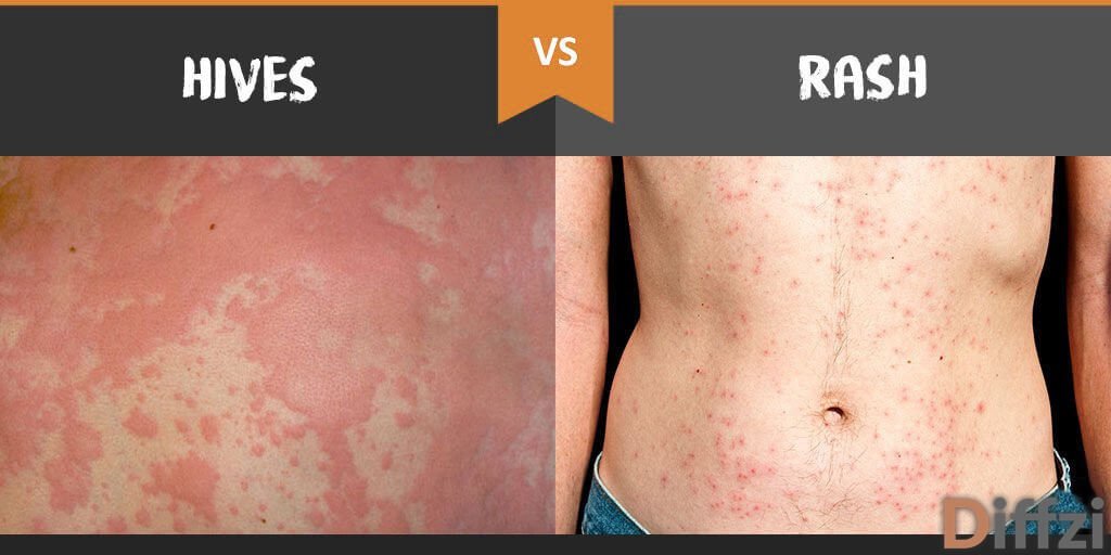 hives vs rash