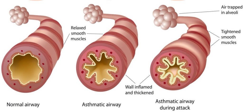 Bronchitis Vs Asthma Difference And Comparison Diffzi - 