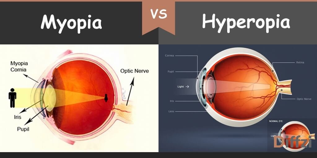 myopia vs hyperopia