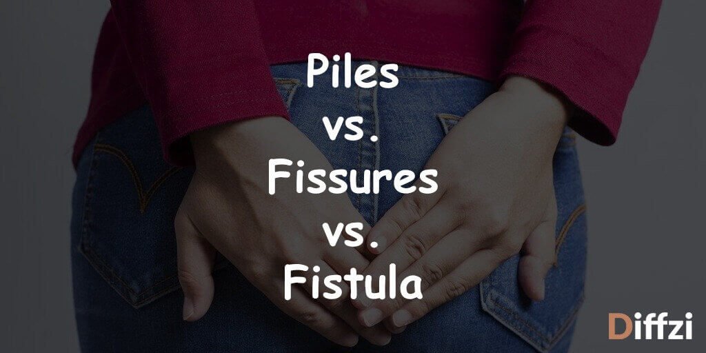 Piles vs. Fissures vs. Fistula