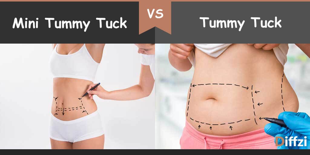 mini-tummy tuck vs tummy tuck
